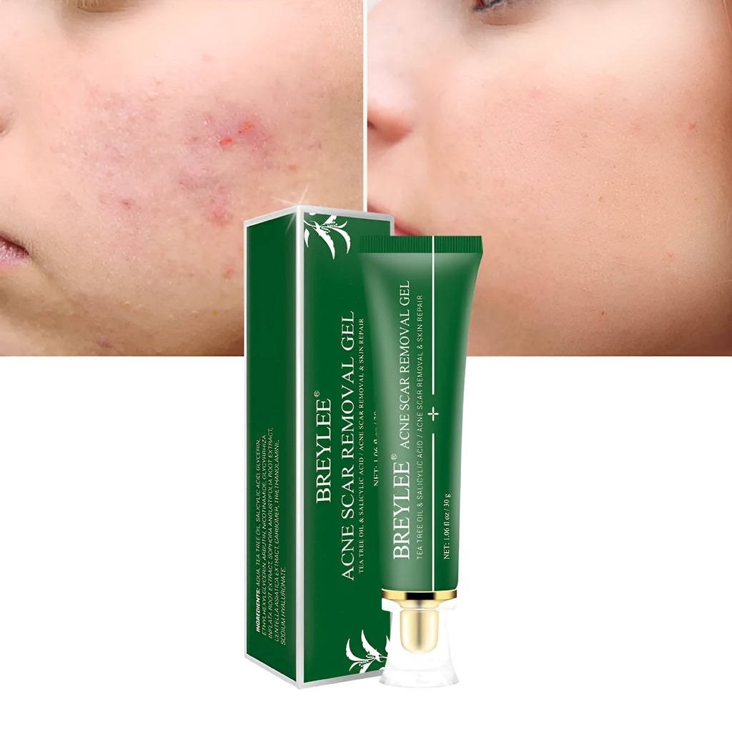 Acne scar removal gel with tea tree oil in a 30g green tube, Qu Dou Printing