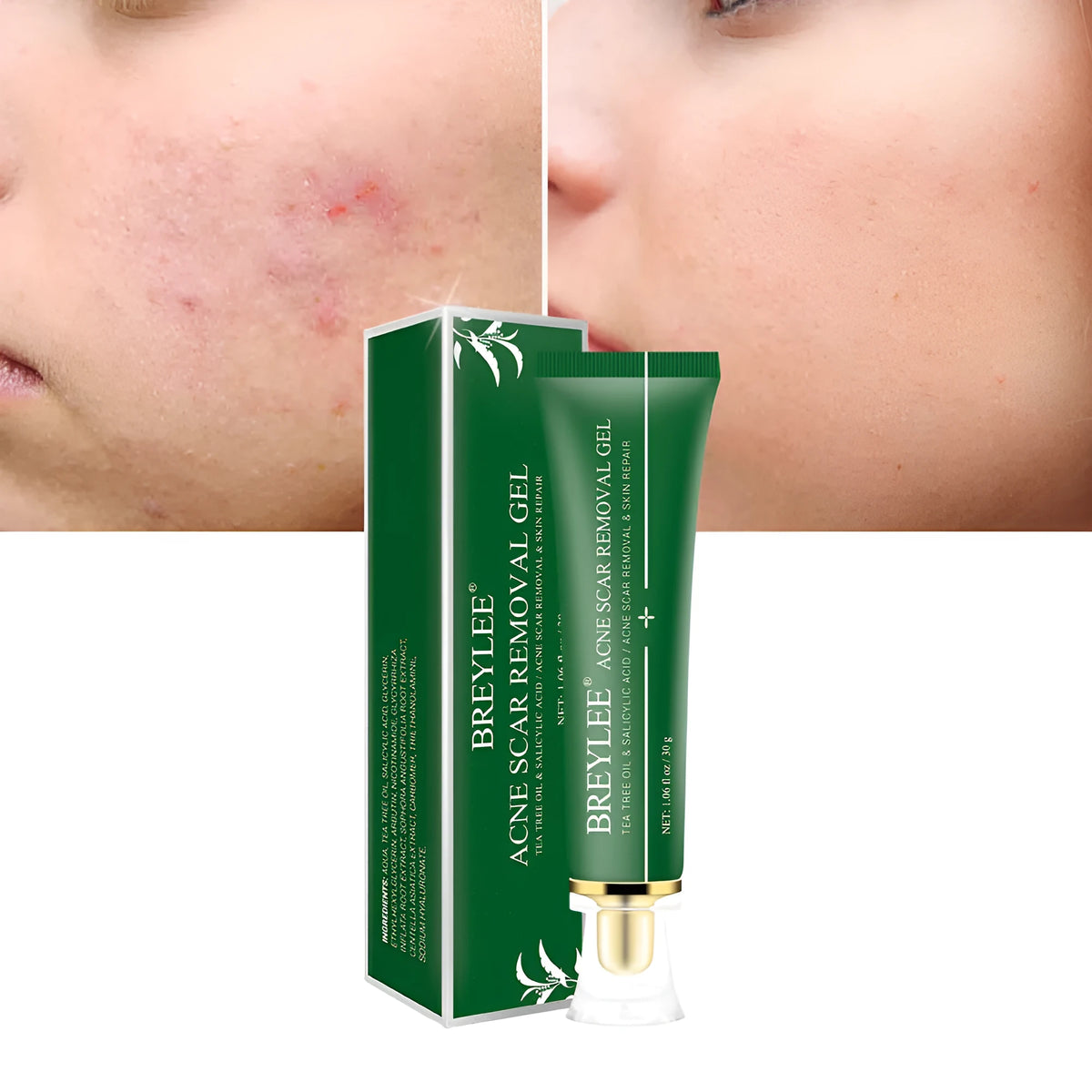 Acne scar removal gel with tea tree oil in a 30g green tube, Qu Dou Printing