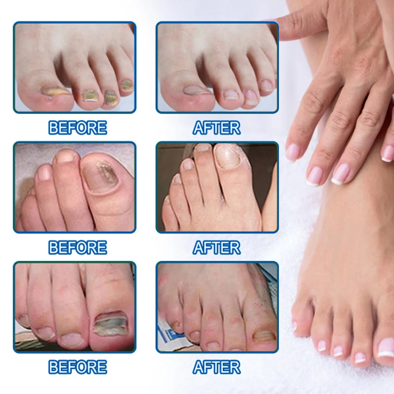 Box of 32 nail repair adhesive bandages for cuticle care, each patch 6.1 cm by 3.5 cm