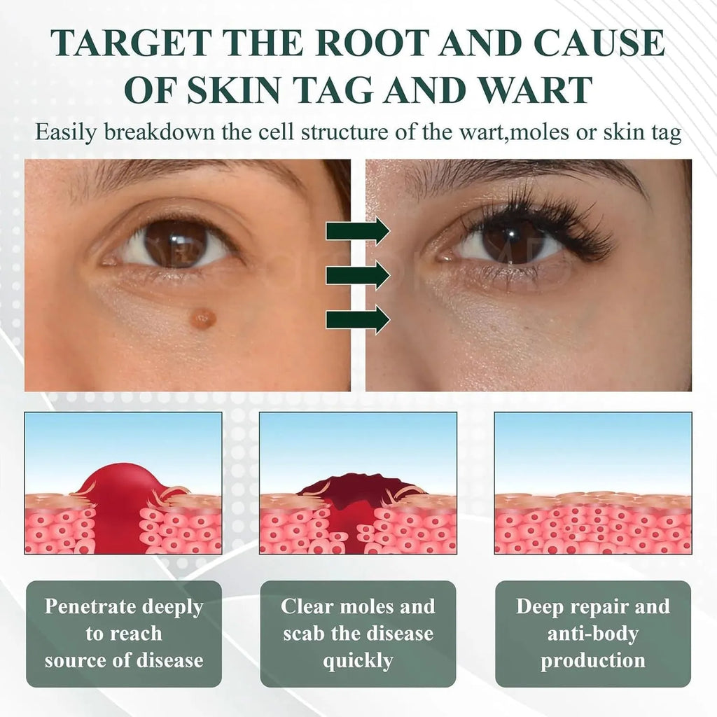 Natureerase Instant Mole Spot Removal Gel 45g tube on white background