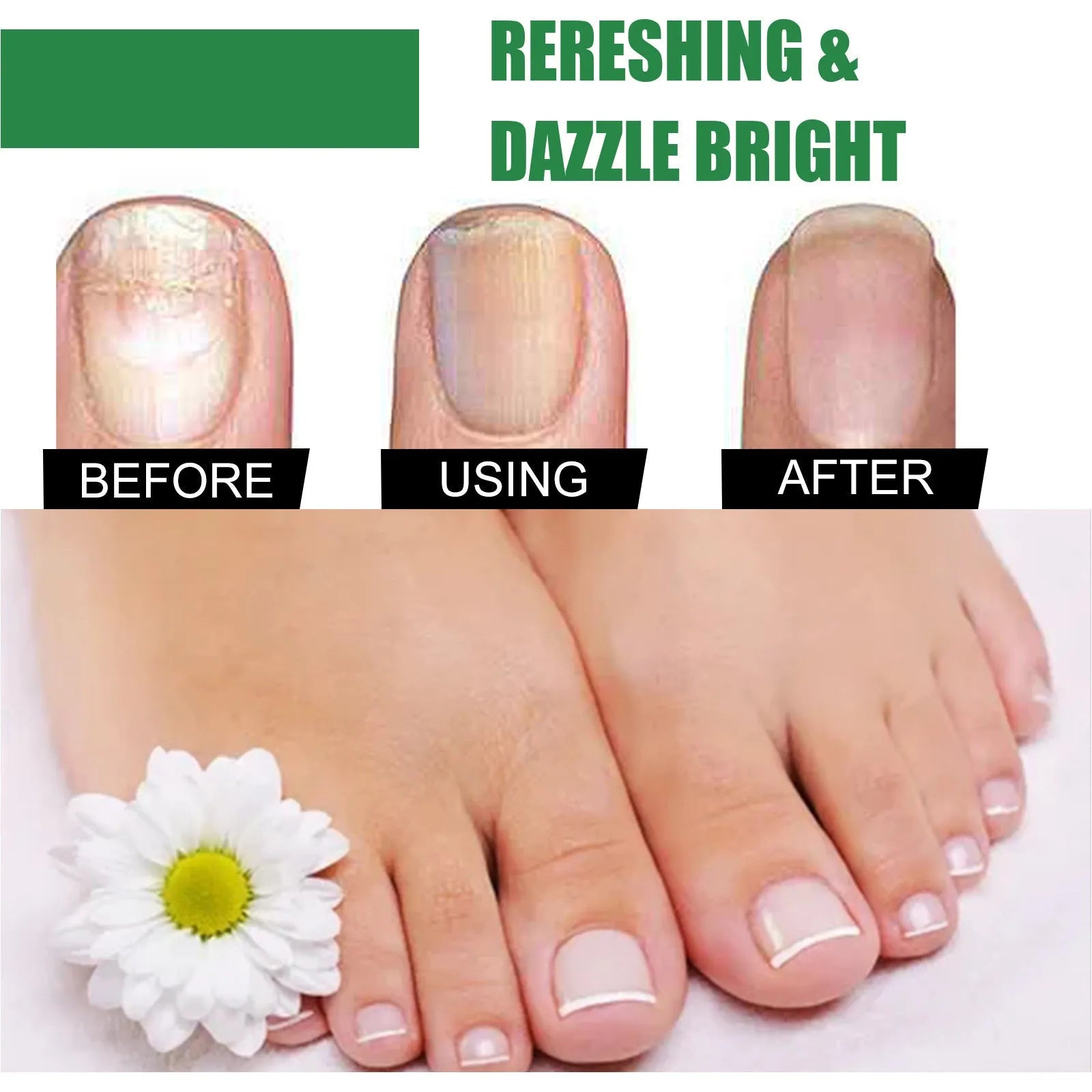 30ml tea tree oil foot and nail treatment bottle for thickened nail care