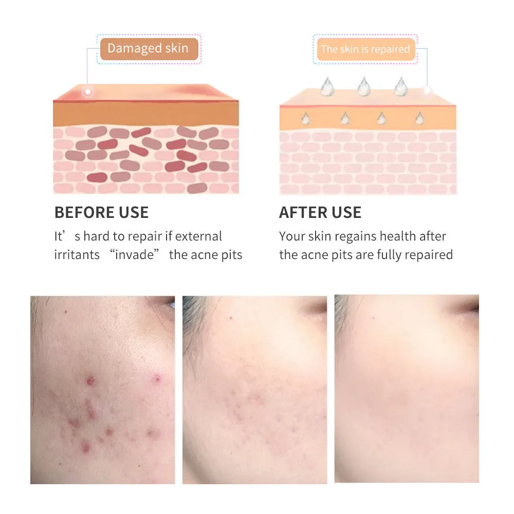 Acne scar removal gel with tea tree oil in a 30g green tube, Qu Dou Printing