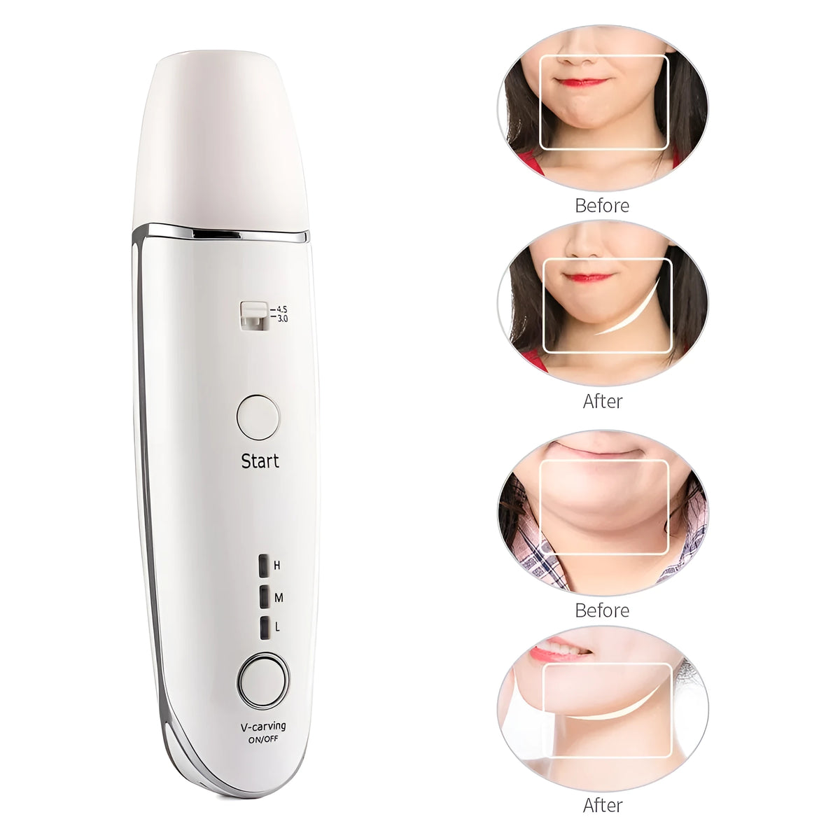 Wrinkle removal V-shape beauty device with RF HIFU, 20W, 17x4cm, ABS, includes syringe and adapter.