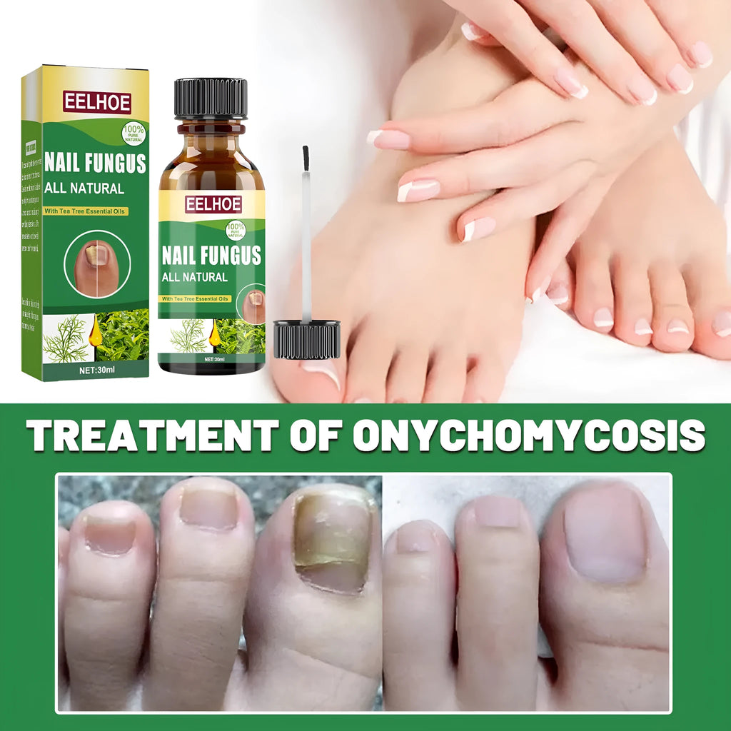 30ml tea tree oil foot and nail treatment bottle for thickened nail care