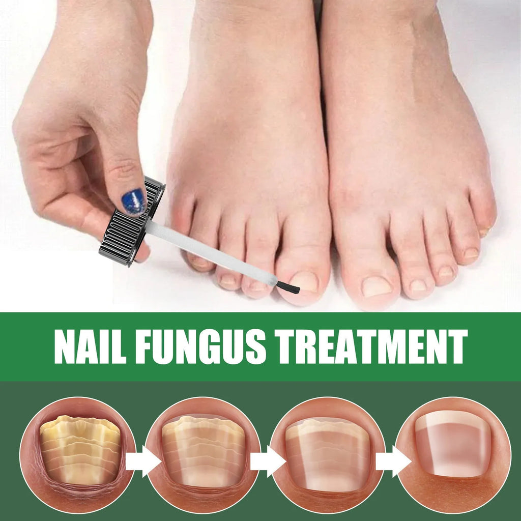 30ml tea tree oil foot and nail treatment bottle for thickened nail care